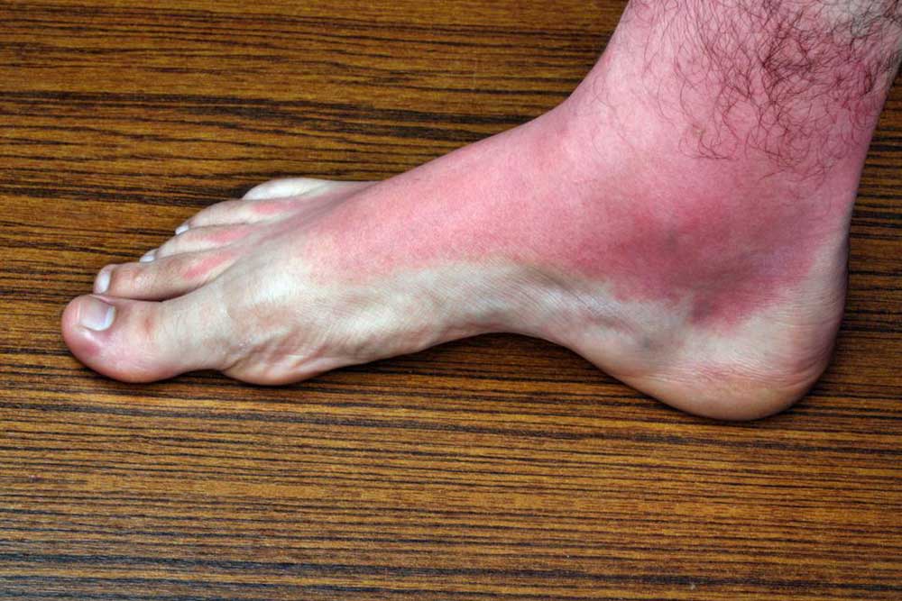Top 7 Reasons for Itchy Rash on Legs and How to Address Them