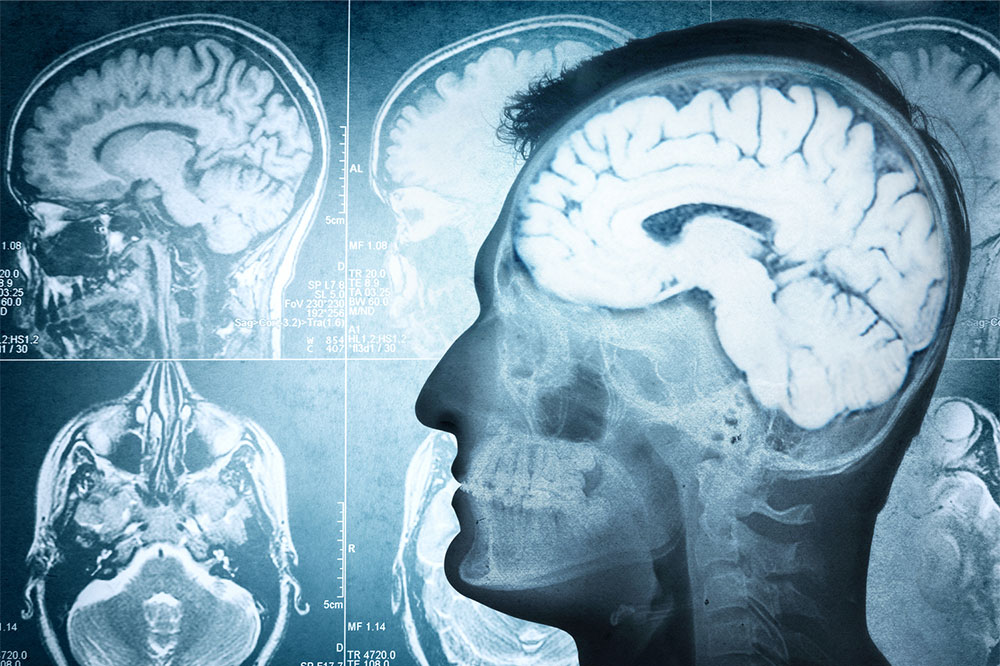 Strategies to Support Brain Health and Prevent Decline