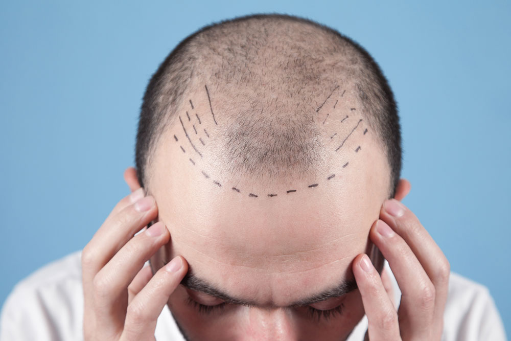 Ultimate Guide to Hair Restoration: Techniques, Costs, and Proven Tips for Success