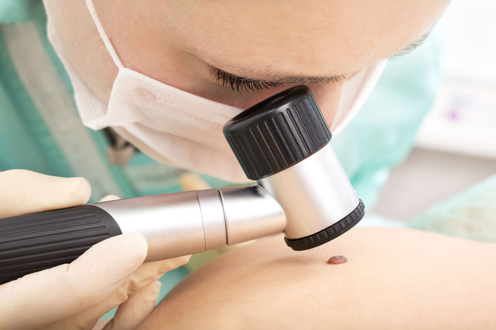 Exploring Systemic Treatments for Advanced Melanoma