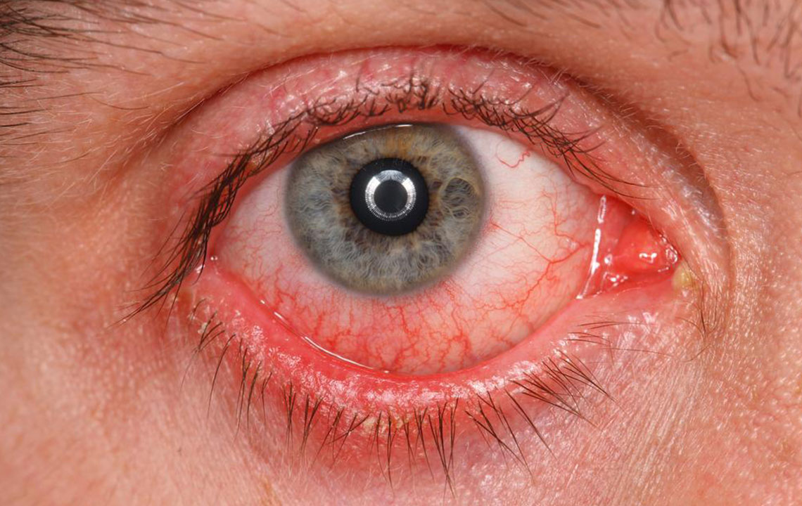 Understanding Pink Eye: Symptoms, Causes, and Effective Treatments