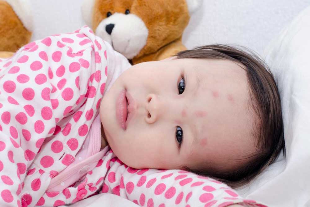 Comprehensive Guide to Identifying and Managing Common Insect Bites for Effective Skin Care