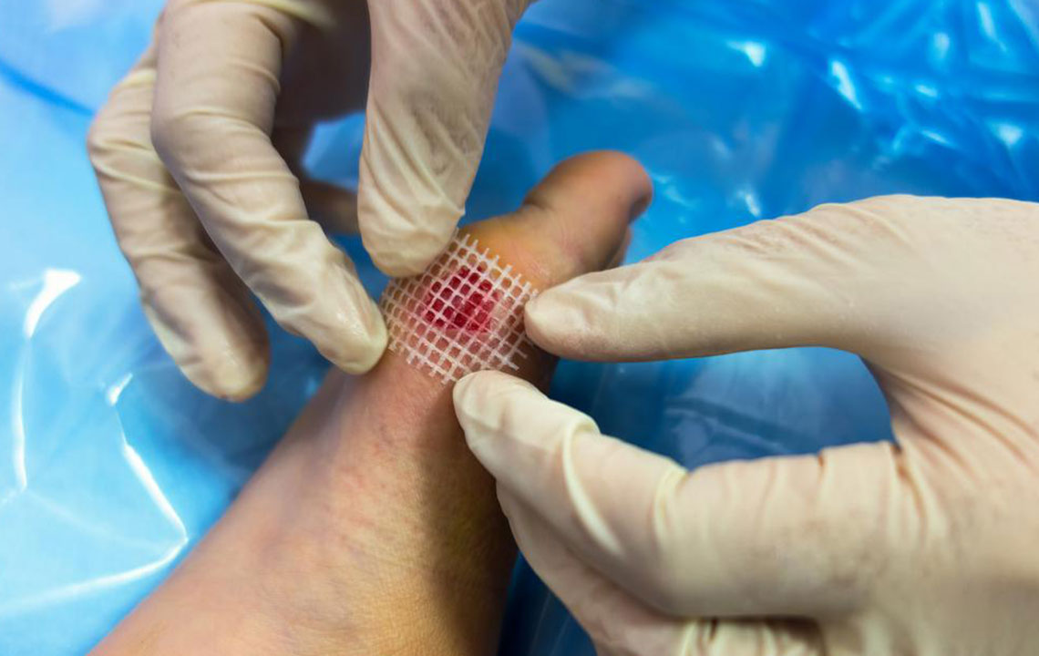 Effective Management and Remedies for Shingles