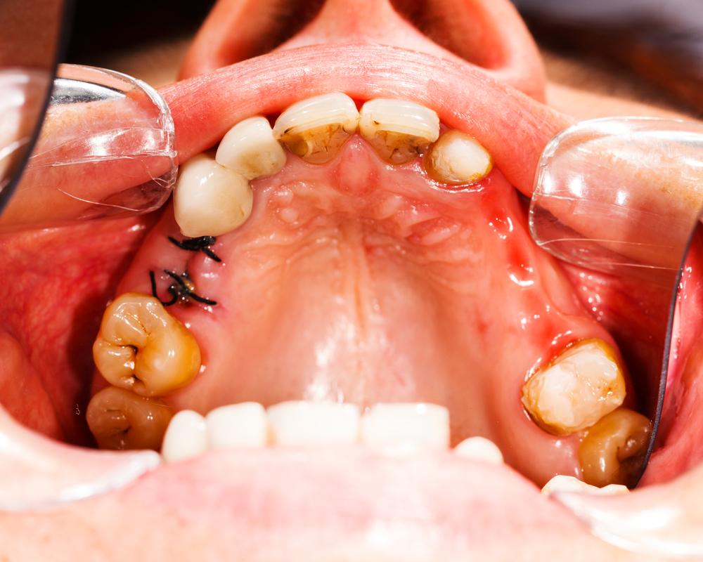 Home-Based Strategies for Cavity Prevention and Treatment