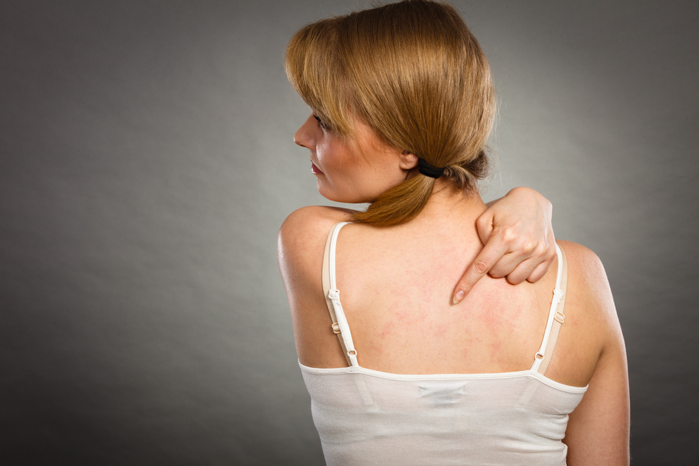 Comprehensive Guide to Eczema Treatments and Home Solutions