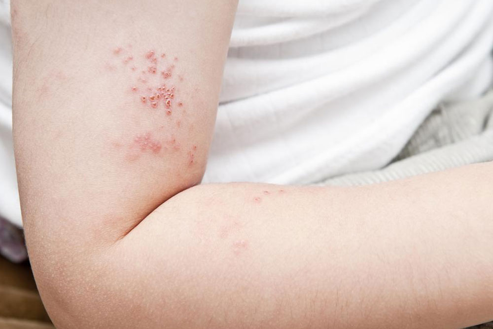 Essential Strategies to Prevent Shingles Before Onset