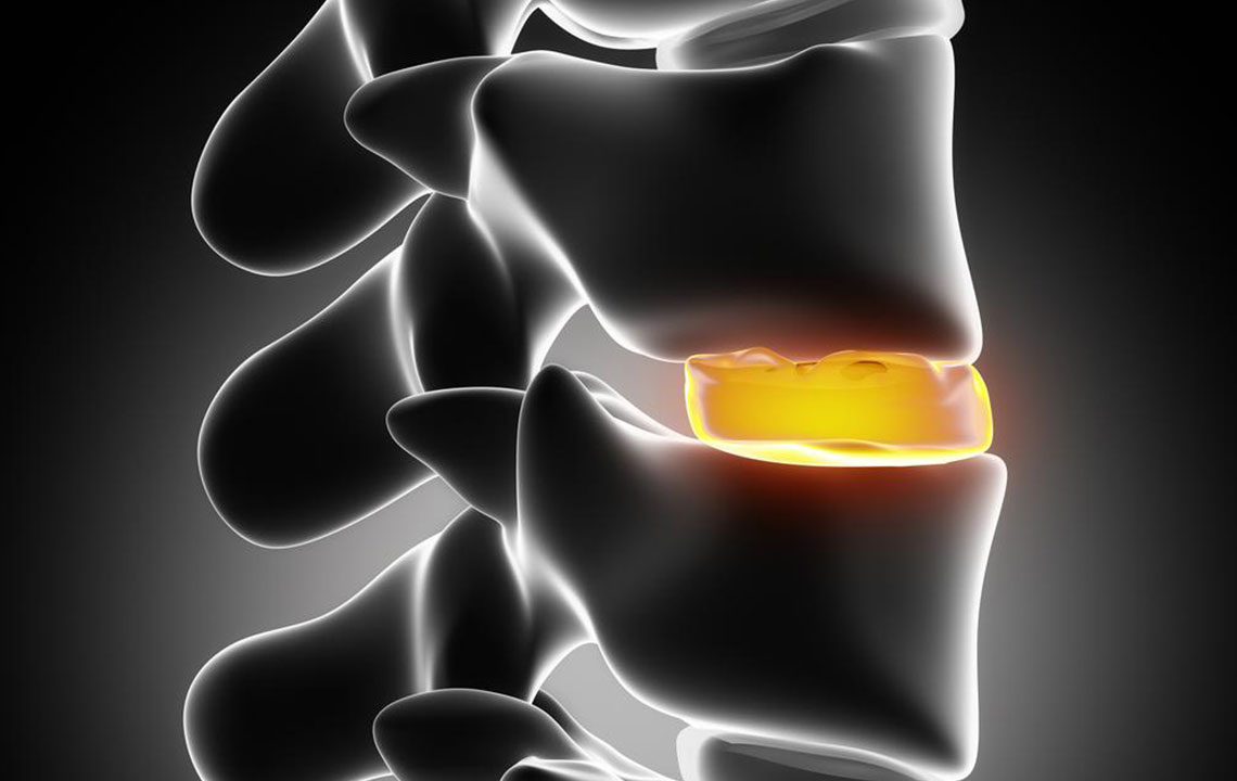 Comprehensive Guide to Managing and Treating Herniated Discs