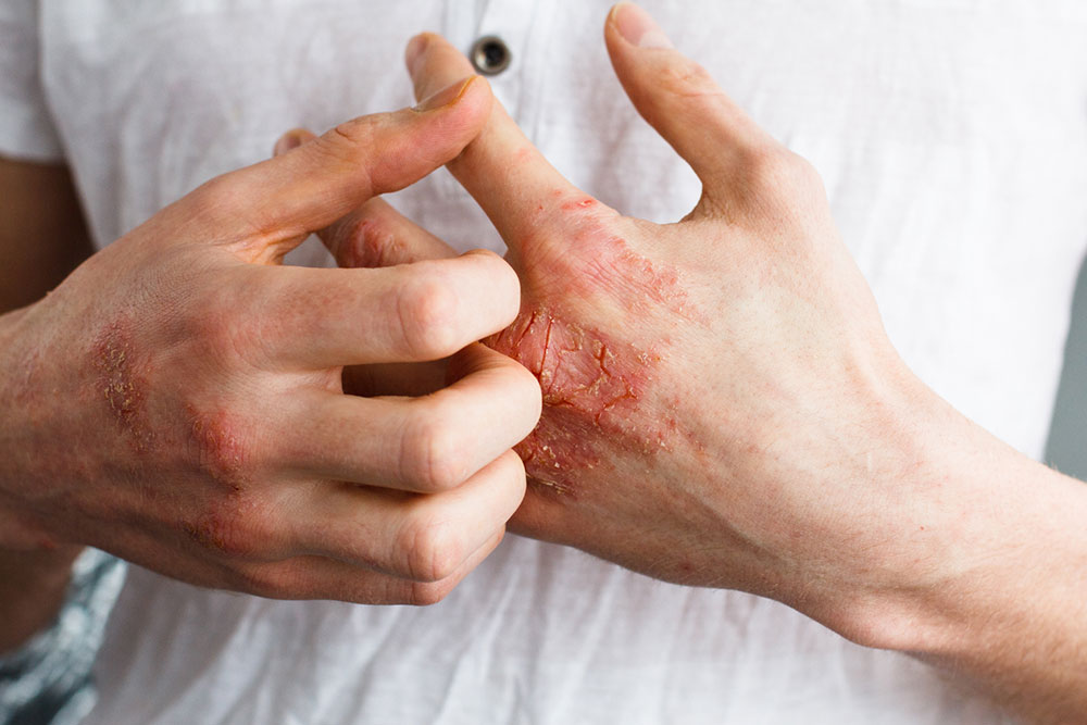 Essential Guide to Managing Eczema Effectively