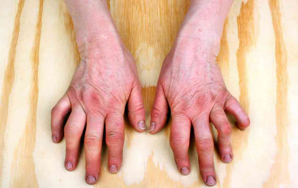 Recognizing Key Signs and Symptoms of Rheumatoid Arthritis