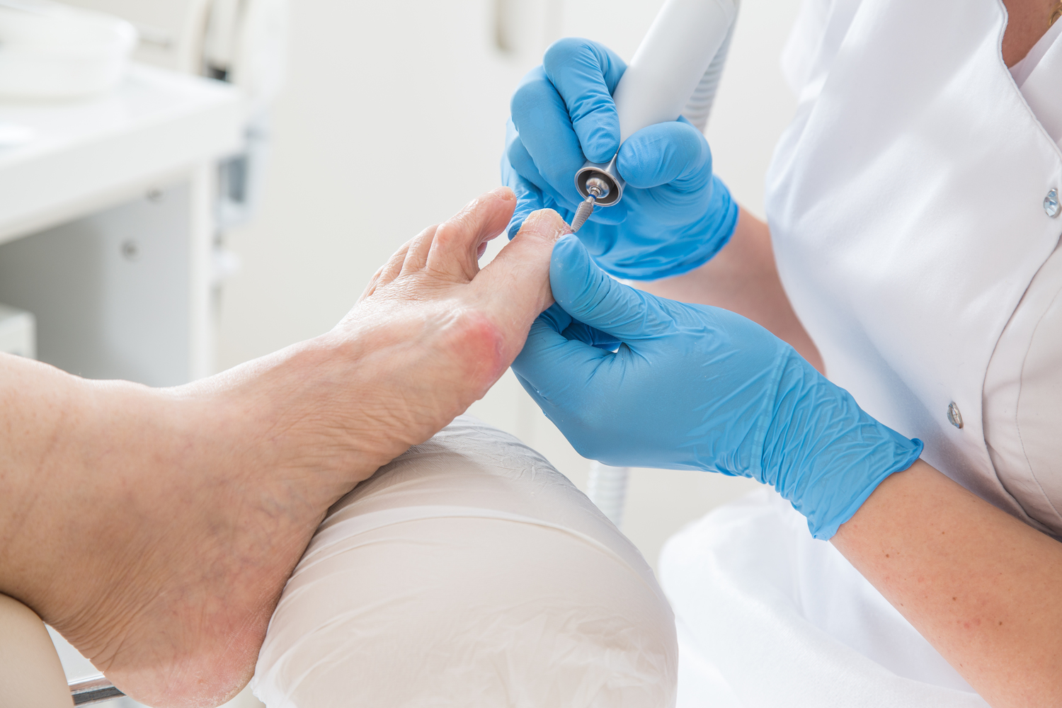 Effective Home Solutions for Toenail Fungal Infections