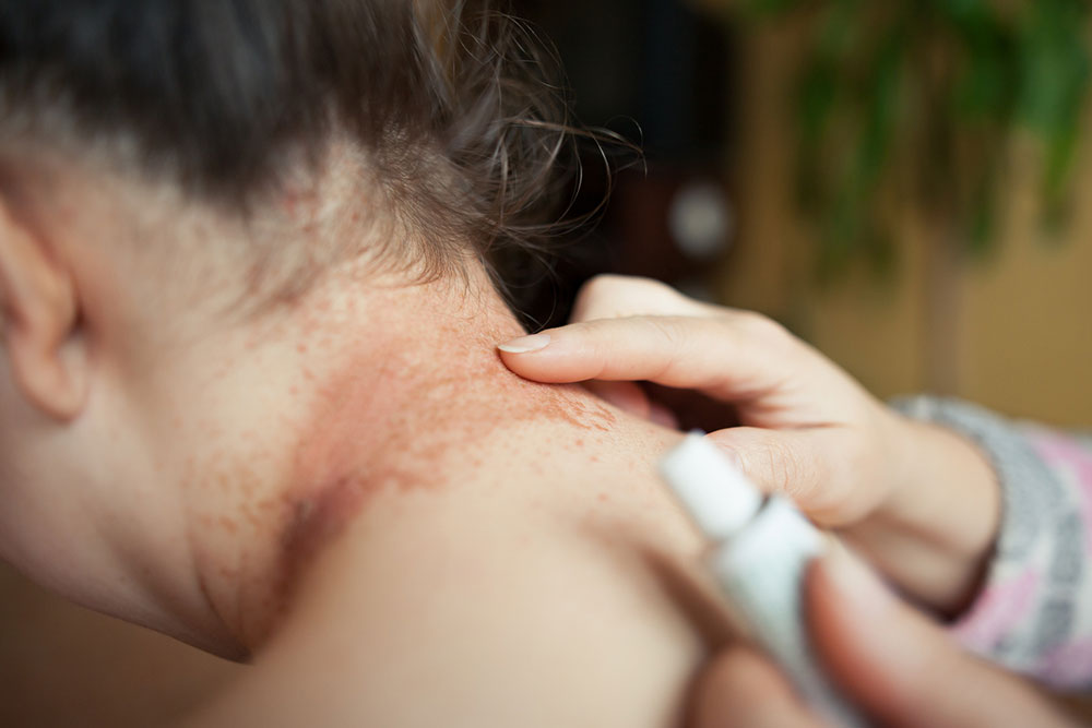 Top 5 Natural Home Remedies to Soothe Eczema Symptoms