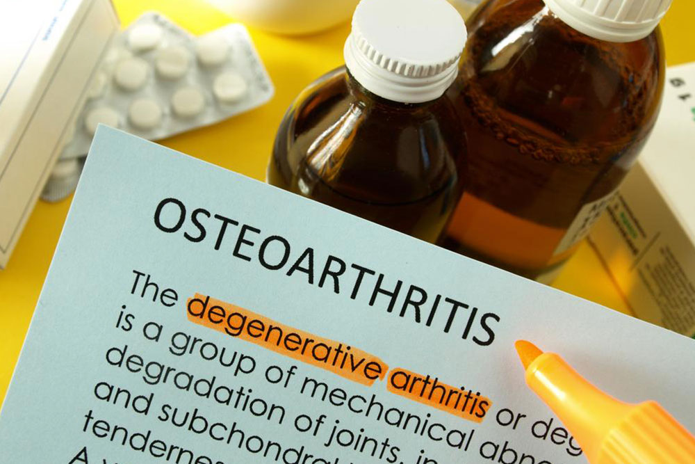 Managing Osteoarthritis: Treatments and Home Remedies