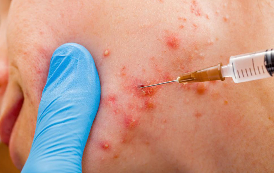 Top Strategies for Clear and Acne-Free Skin