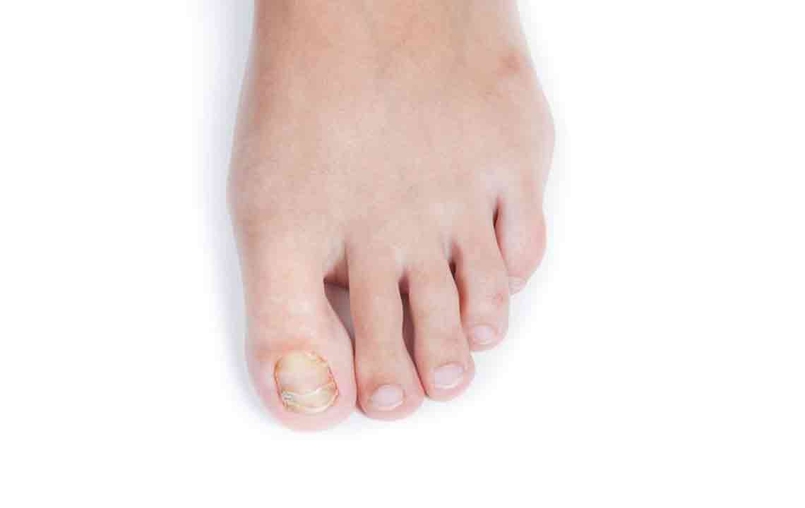 Effective Strategies for Managing Toenail Fungal Infections