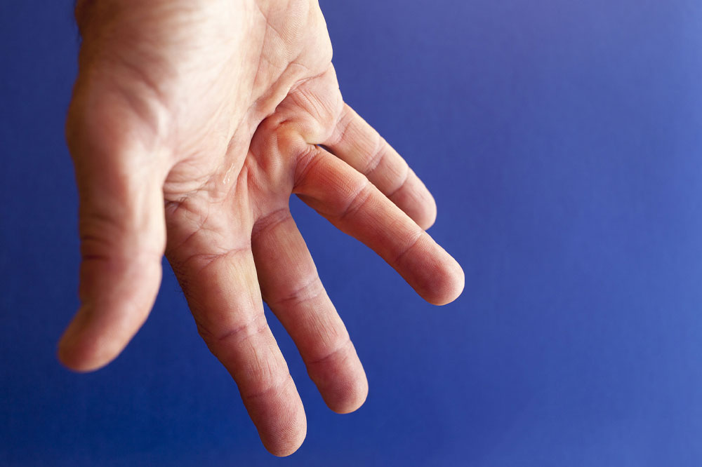 Understanding Dupuytren’s Disease: Causes, Symptoms, and Natural Management