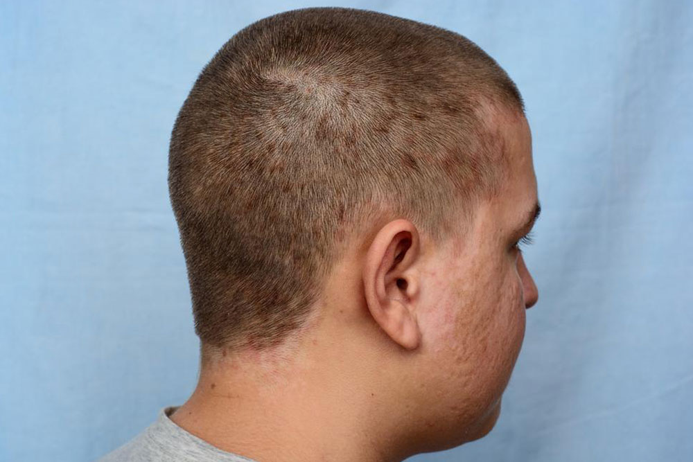 Comprehensive Guide to Managing Scalp Seborrheic Dermatitis Effectively