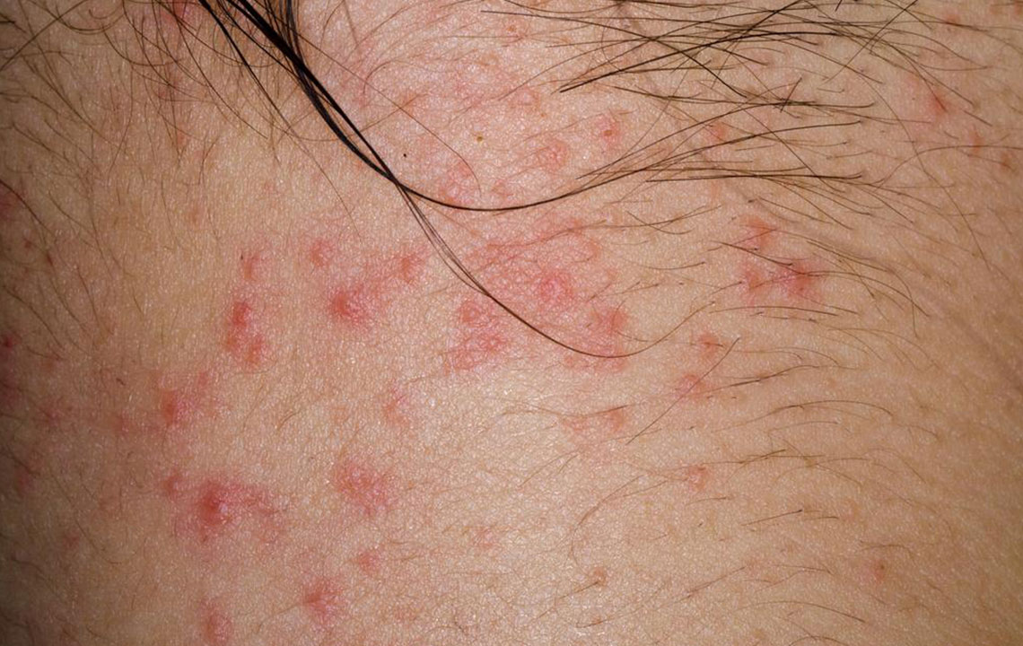 Comprehensive Guide to Eczematous Dermatitis: Types and Symptoms