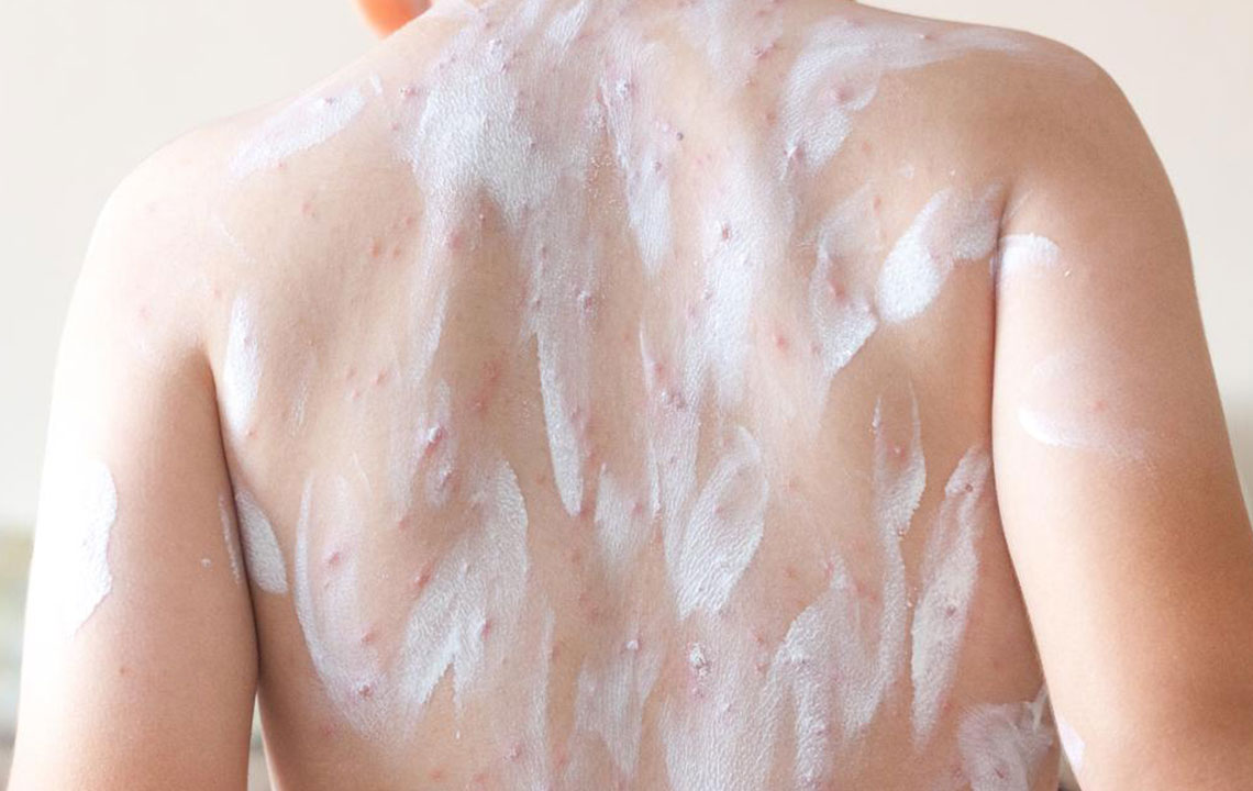 Effective Home Remedies and Treatments for Atopic Dermatitis
