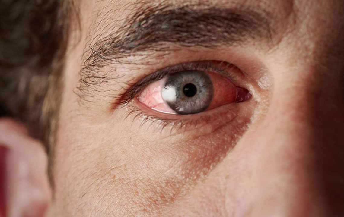 Effective Strategies for Treating Red Eyes