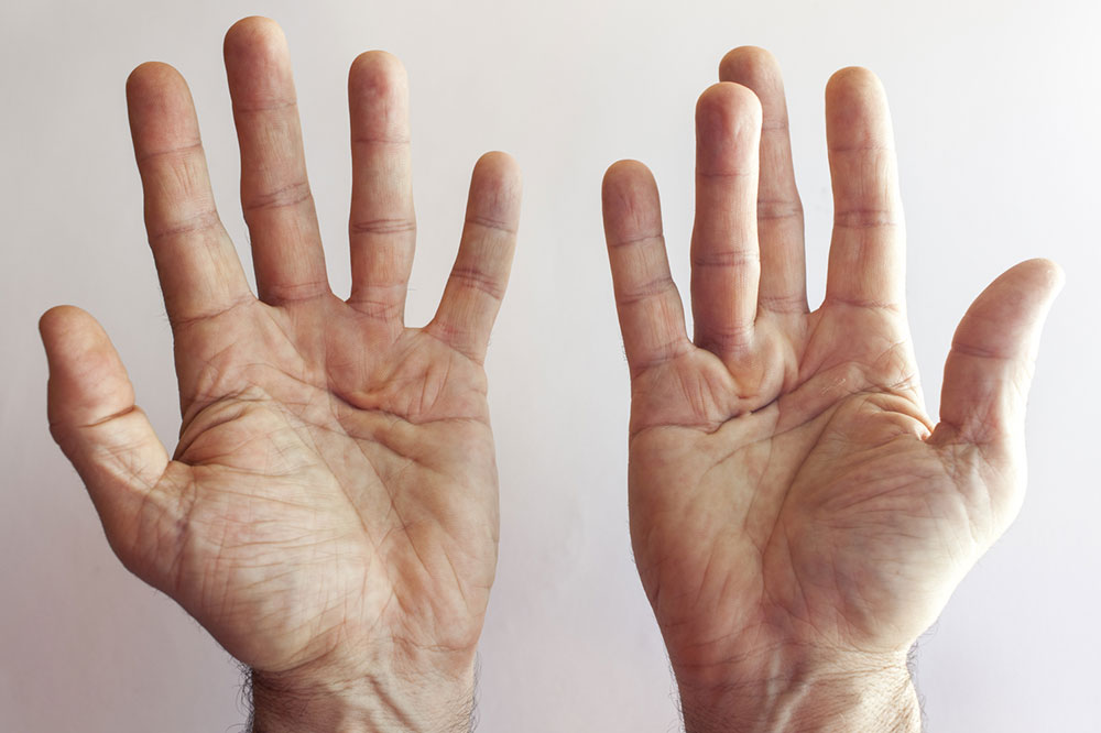 Effective Hand Exercises for Managing Dupuytren's Contracture