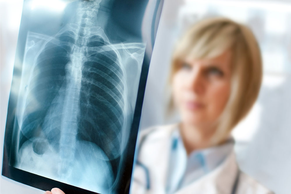 Understanding Lung Nodules: Causes and Treatment Strategies