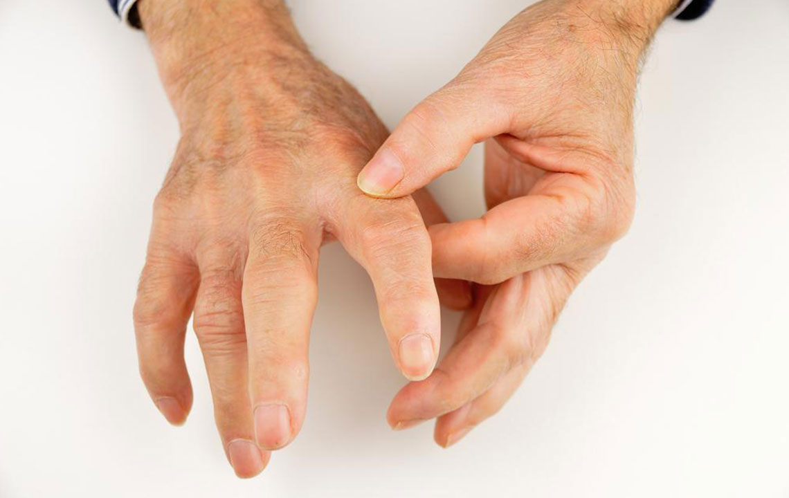 Effective Strategies for Managing Rheumatoid Arthritis and Gout