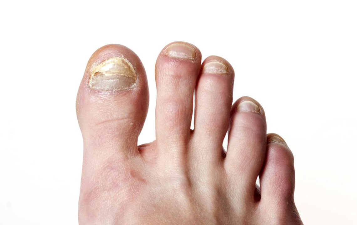 Recognizing Early Symptoms of Toenail Fungal Infections