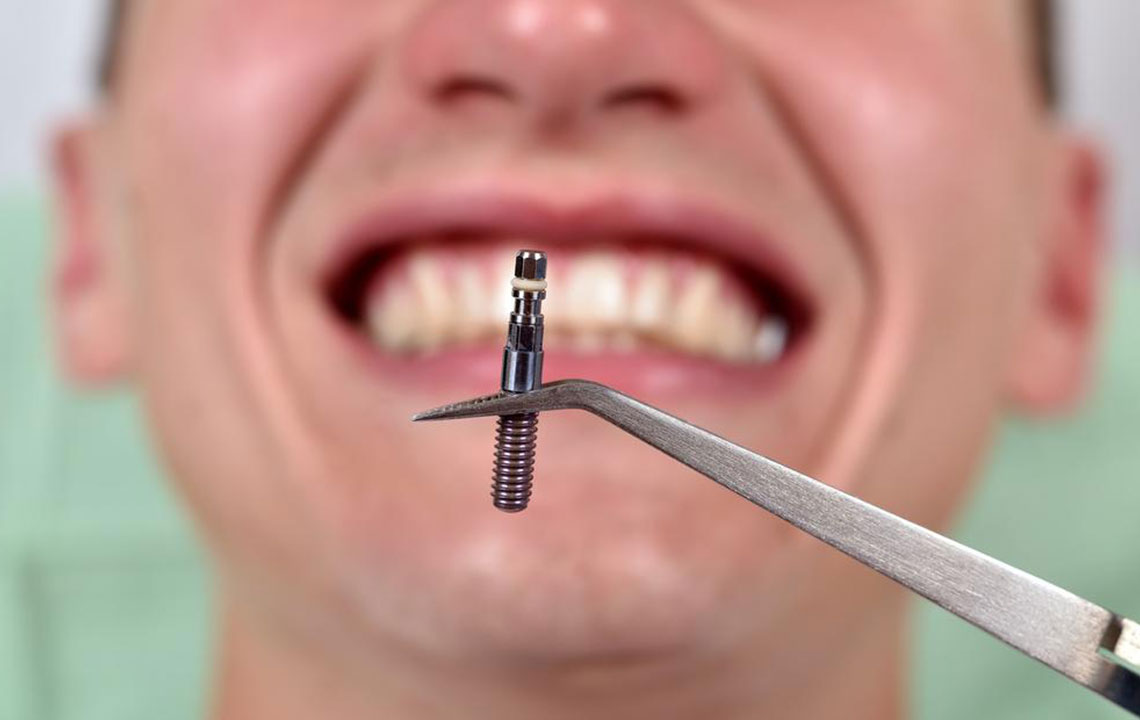 Understanding the Costs of Dental Implants and Alternatives