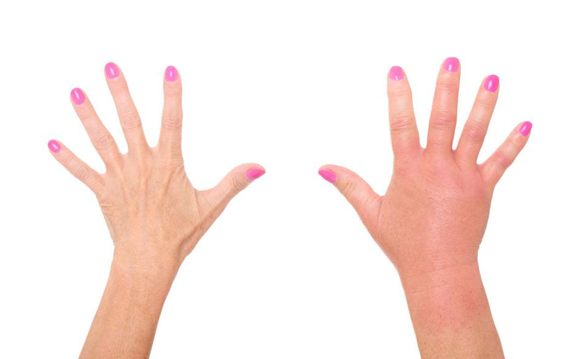Debunking Common Myths About Hepatitis C