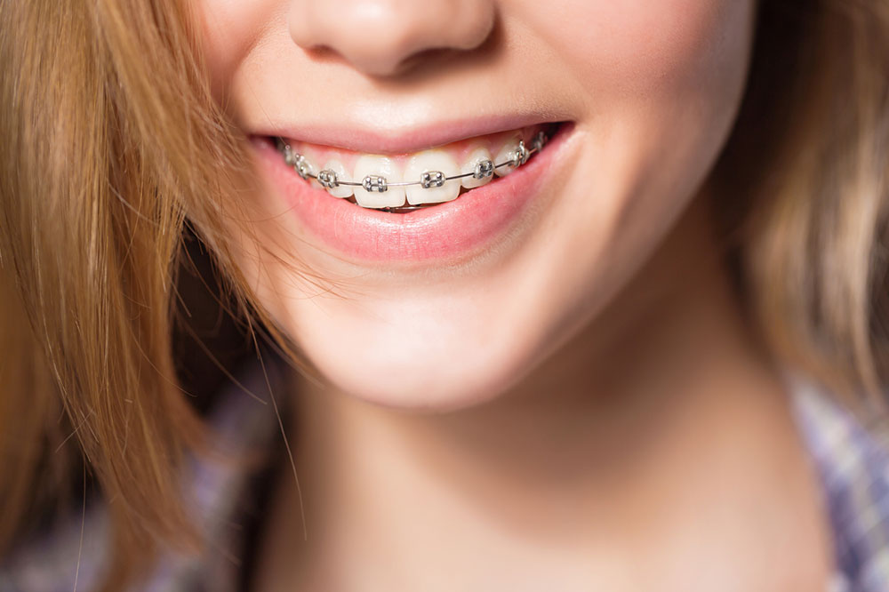 Comprehensive Guide to the Top 4 Teeth Braces Solutions for Adult Orthodontic Treatments