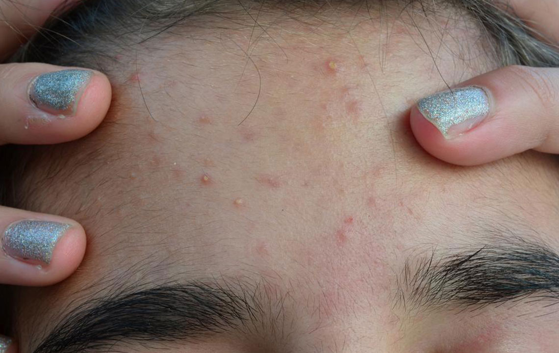 Top 5 Acne Solutions for Clear and Radiant Skin