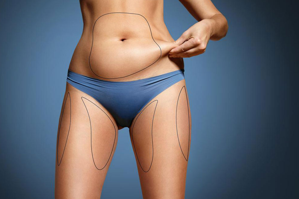 Discovering Coolsculpting: A Non-Invasive Fat Reduction Technique