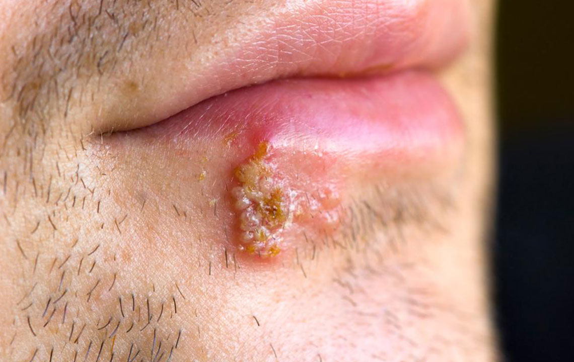 Effective Strategies for Managing Herpes Outbreaks