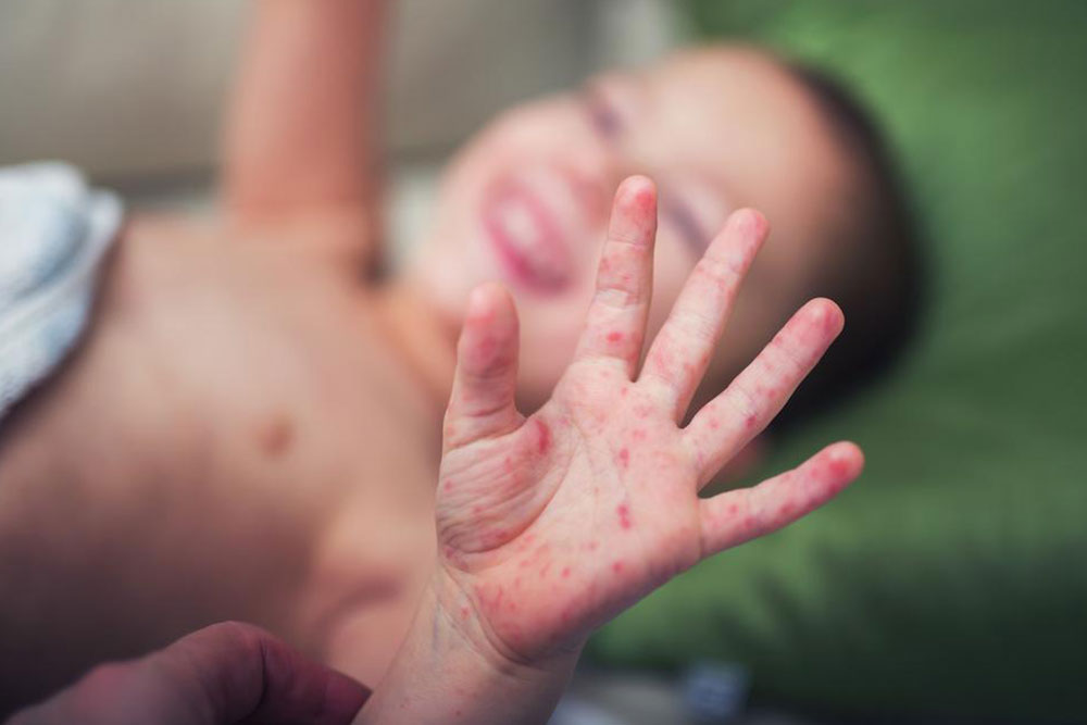 Understanding Hand-Foot-and-Mouth Disease: Causes and Symptoms