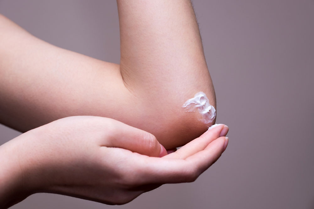 Comprehensive Guide to Ringworm: Causes, Symptoms, and Effective Prevention Methods