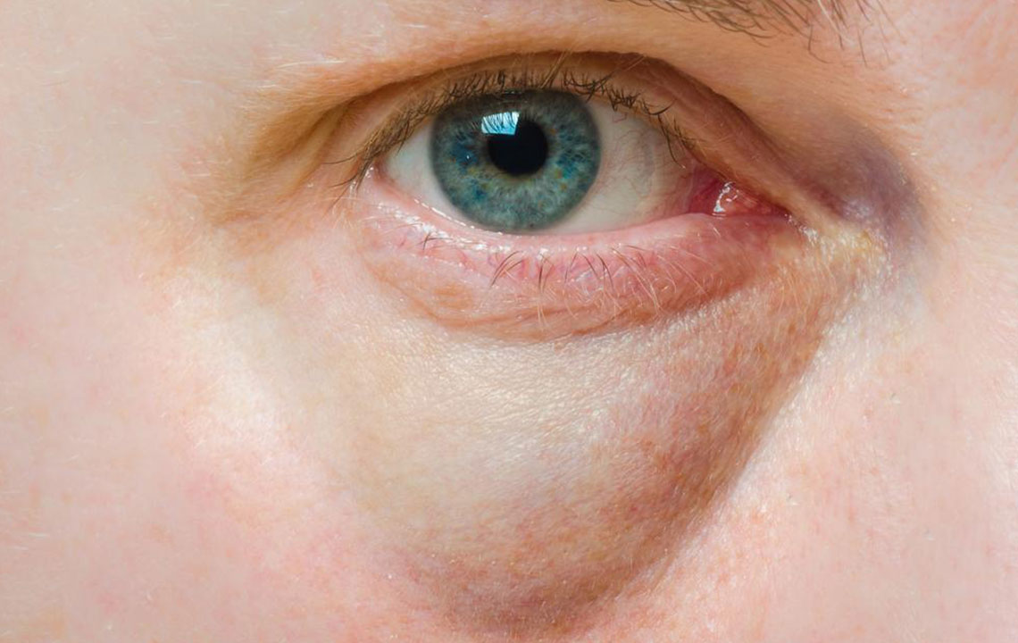 Under-Eye Puffiness: Causes, Symptoms, and Effective Remedies