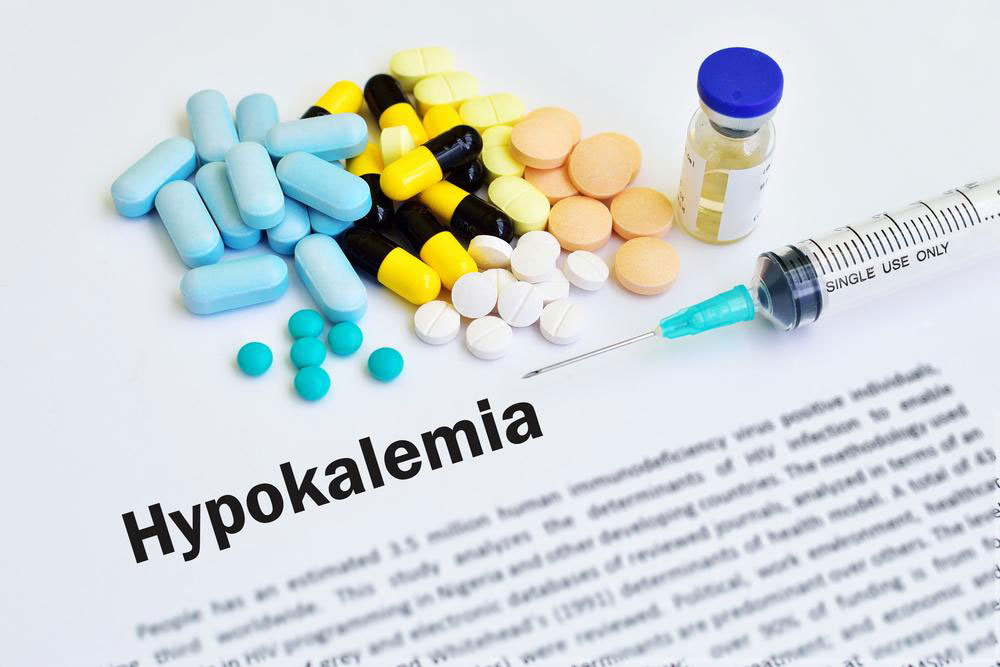 Understanding Hypokalemia: Causes, Symptoms, and Management