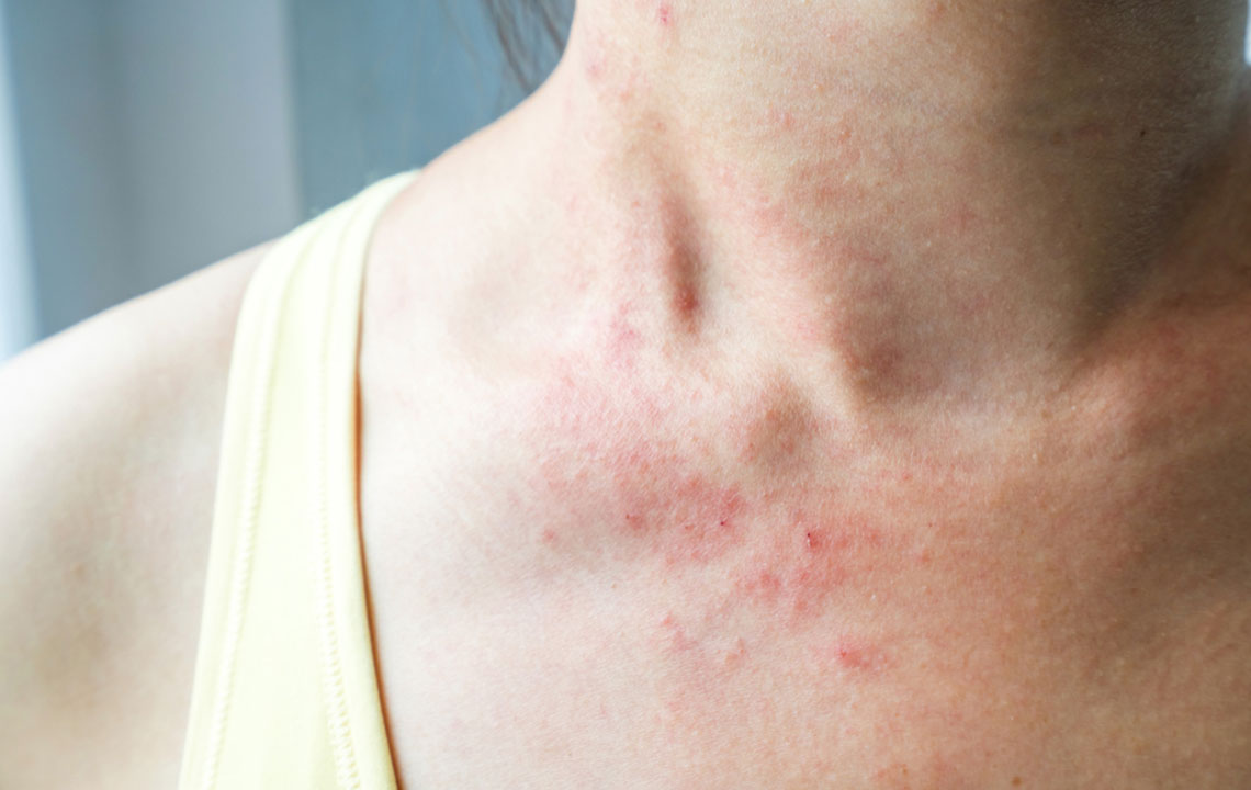 Essential Guide to Understanding Cellulitis