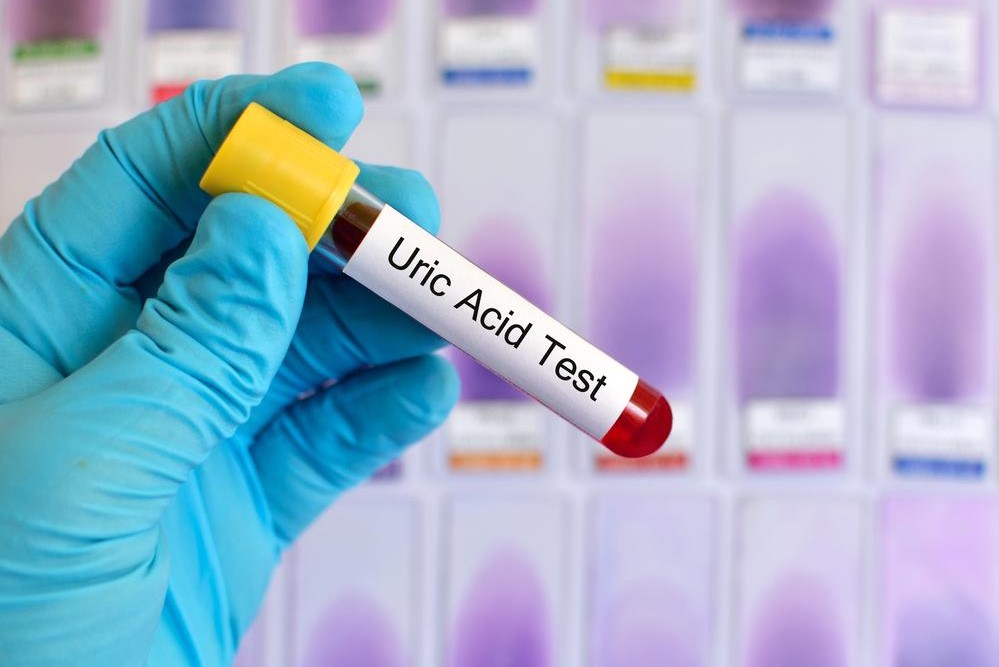 Comprehensive Guide to Gout: Diagnosis, Testing, and Evaluation Strategies