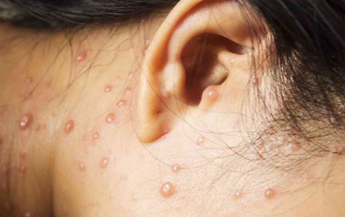 Comprehensive Guide to Shingles and Its Management