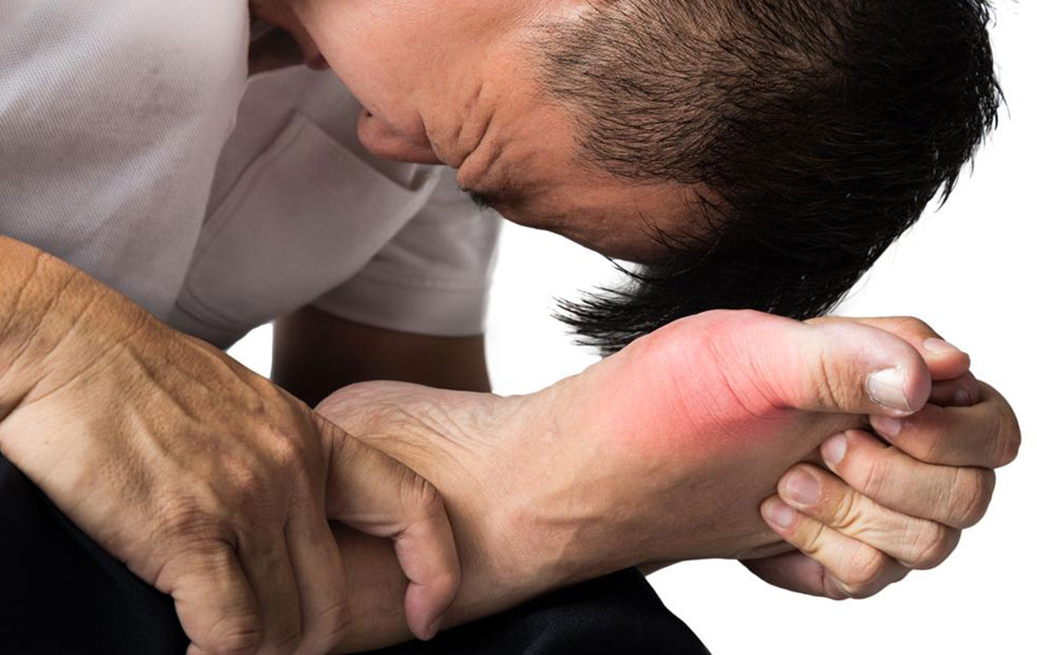 Effective Strategies for Managing Gout and Preventing Flare-Ups