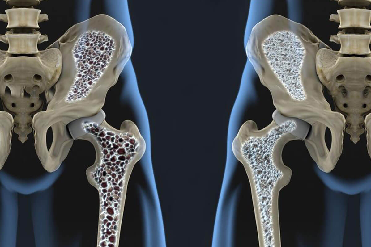 Medical Conditions That Contribute to Osteoporosis and Bone Loss