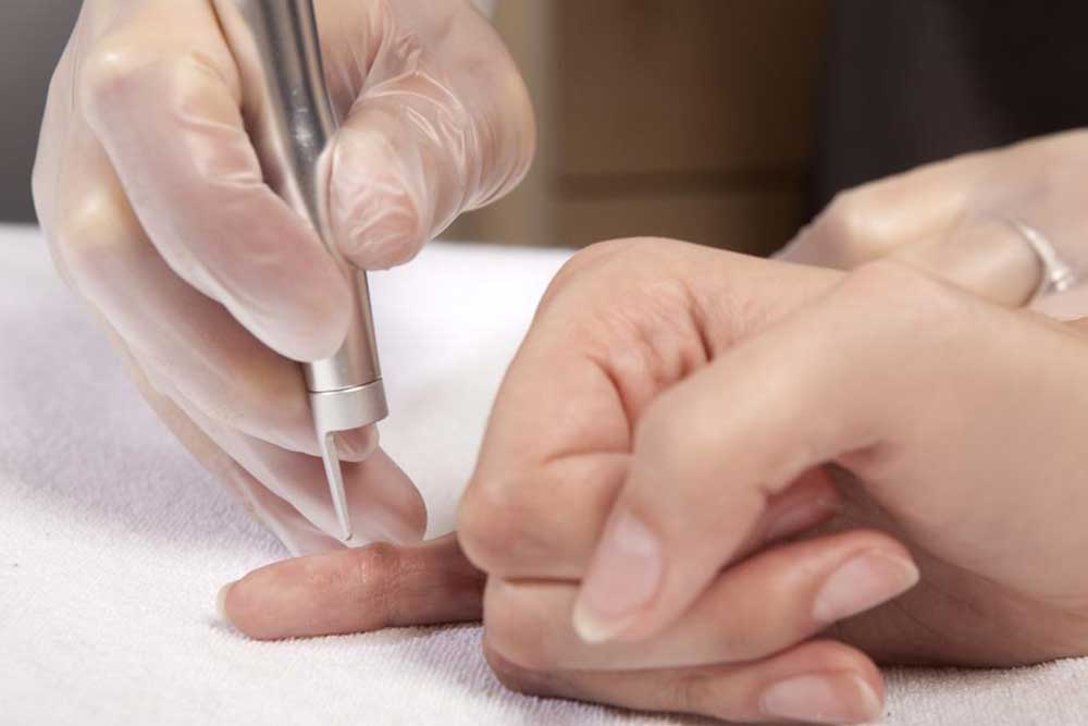 Effective Strategies to Eliminate Warts