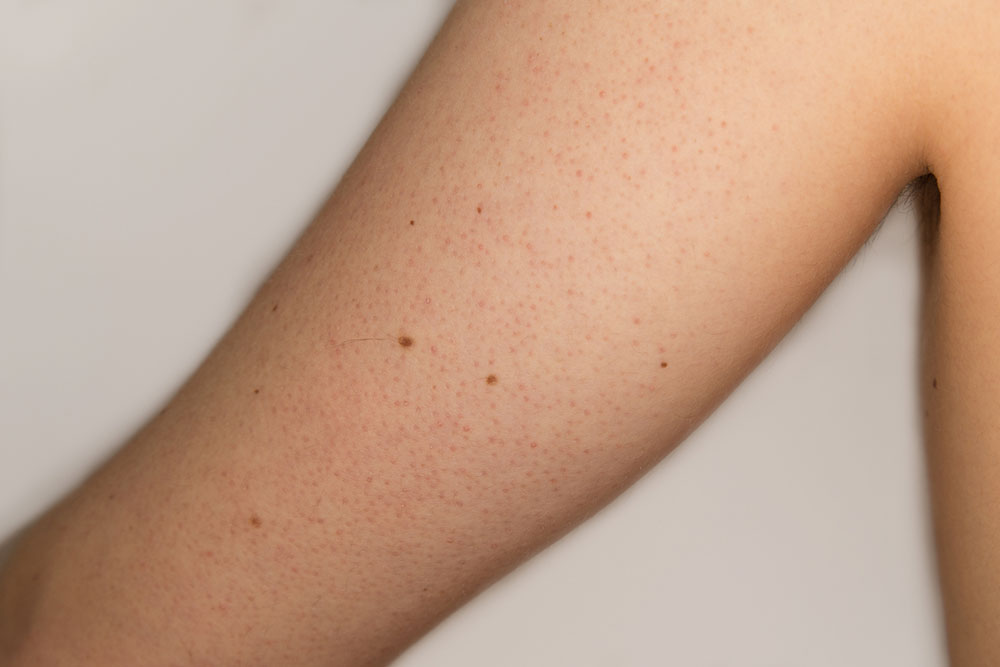 Effective Strategies to Treat Keratosis Pilaris