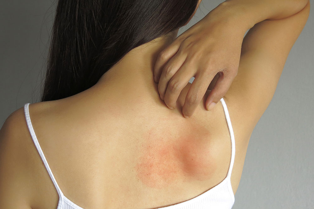 Essential Facts About Allergies and Effective Management Strategies