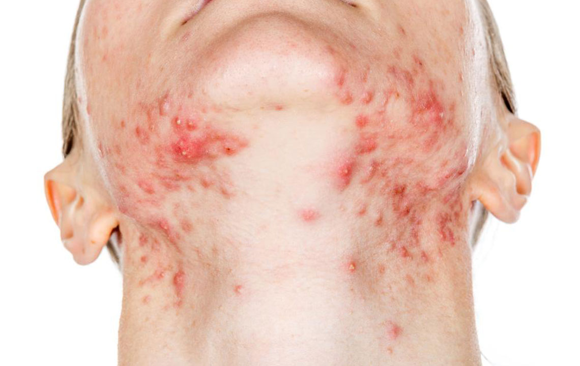 Comprehensive Natural Strategies to Alleviate Shingles Symptoms and Accelerate Healing