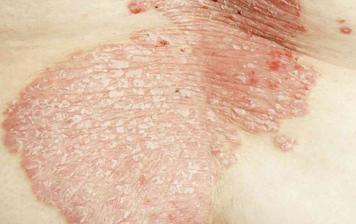 Understanding the 7 Main Types of Eczema
