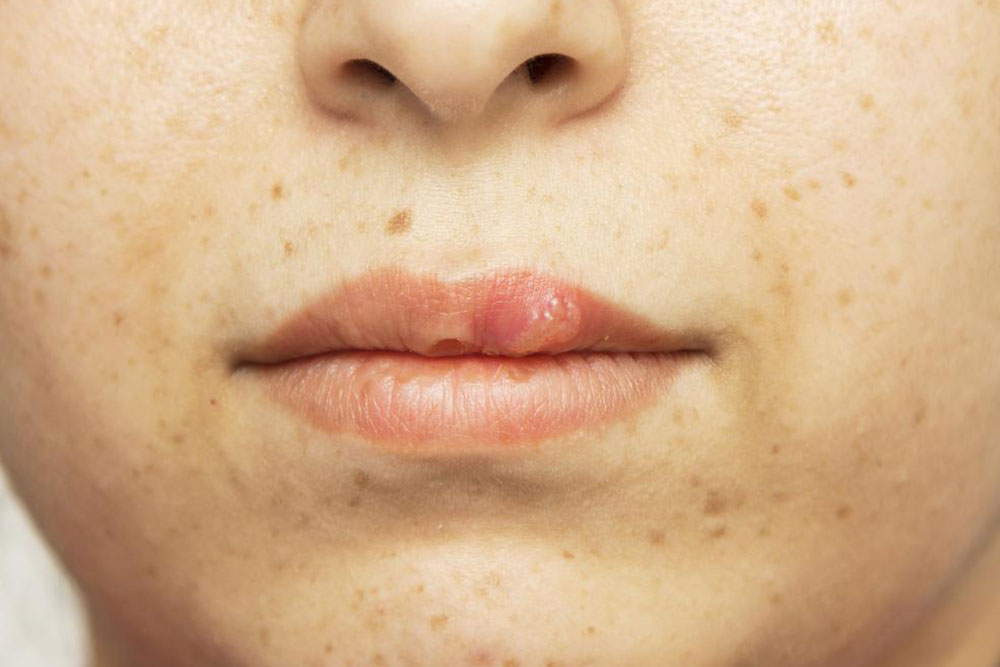 Effective Home Remedies for Fast Blister Recovery