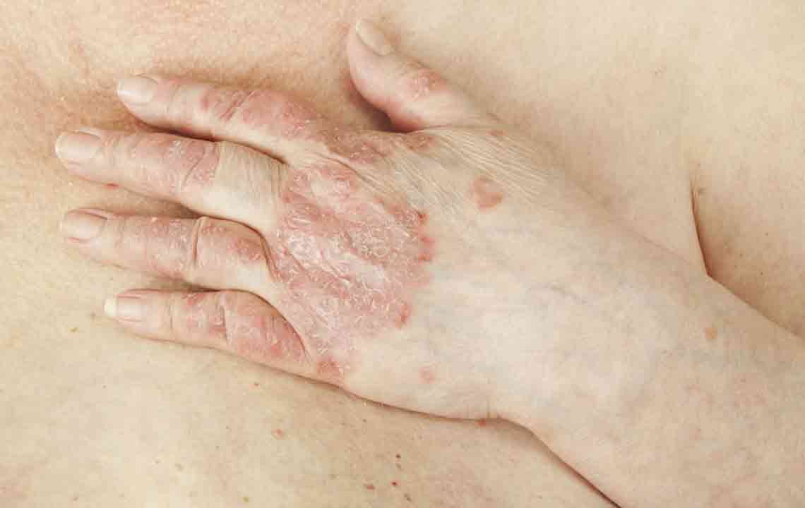 Comprehensive Guide to Understanding and Managing Psoriasis