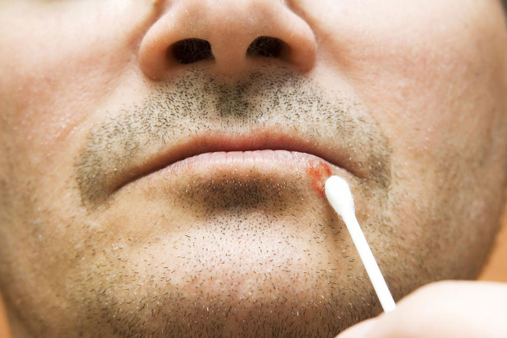 Effective Strategies and Medications for Healing Canker Sores